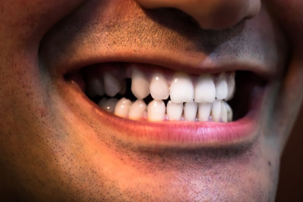Close-up of a smiling mouth showing crowded teeth and slight stubble on the face.